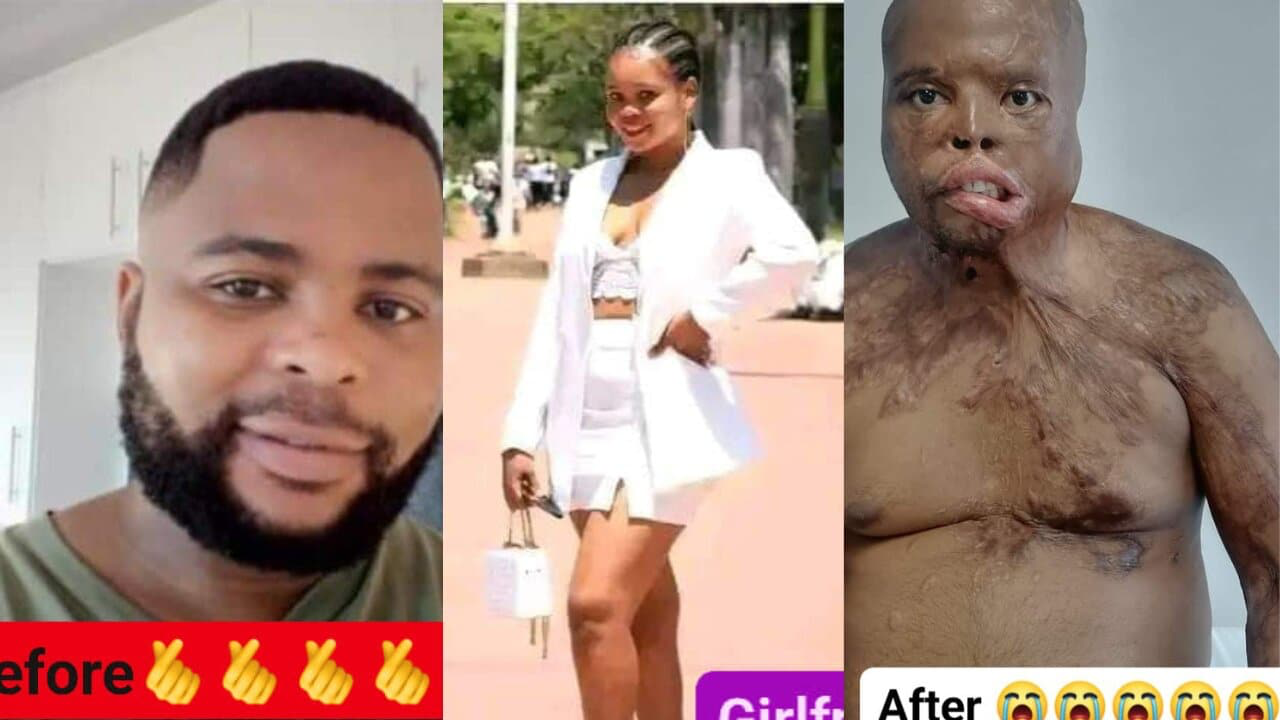 Lady pours acid on her boyfriend for allegedly cheating on her (Photos)